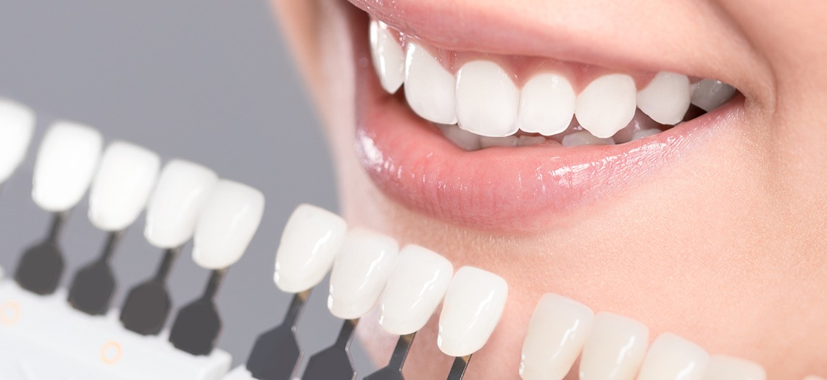 Preguntas frecuentes sobre el blanqueamiento dental