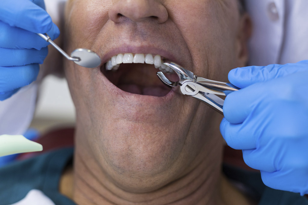 ¿Qué no es normal después de una extracción dental?