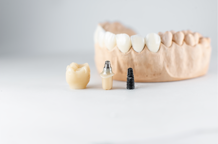 Conseguir sonrisas duraderas: Descubre las ventajas de los implantes dentales