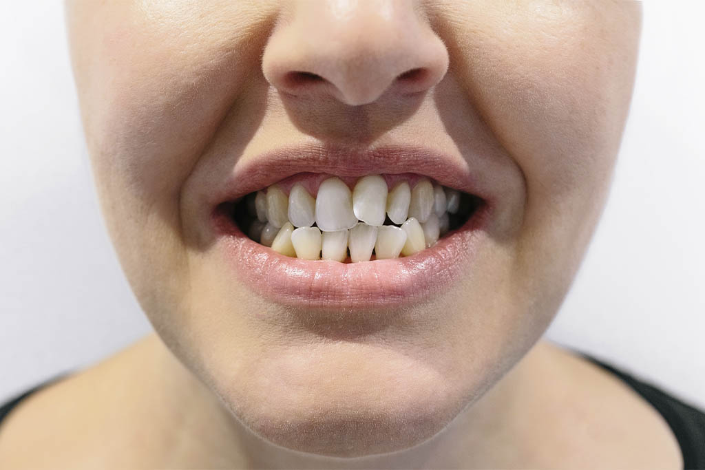 Corrige tu maloclusión dental y consigue una sonrisa saludable